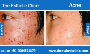 acne-treatment-before-after-photos-mumbai-india-1 (1)
