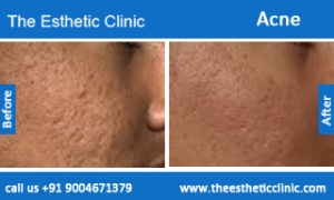 acne-treatment-before-after-photos-mumbai-india-1 (2)