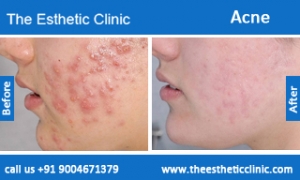 acne-treatment-before-after-photos-mumbai-india-1 (4)