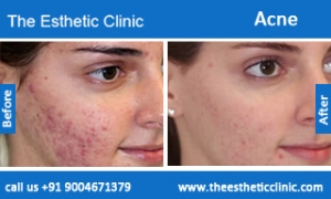 acne-treatment-before-after-photos-mumbai-india-1 (5)