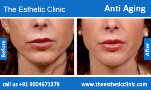 Anti-Aging-treatment-before-after-photos-mumbai-india-1 (2)