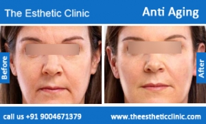 Anti-Aging-treatment-before-after-photos-mumbai-india-1 (4)