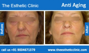 Anti-Aging-treatment-before-after-photos-mumbai-india-1 (5)