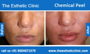 Chemical-Peel-treatment-before-after-photos-mumbai-india-1 (5)
