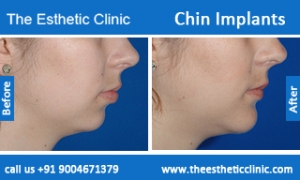 Chin-Implants-before-after-photos-mumbai-india-5
