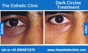 Dark-Circles-treatment-before-after-photos-mumbai-india-1 (1)