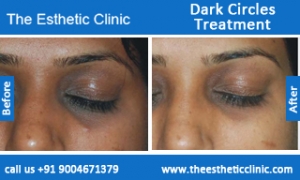 Dark-Circles-treatment-before-after-photos-mumbai-india-1 (2)