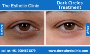 Dark-Circles-treatment-before-after-photos-mumbai-india-1 (3)