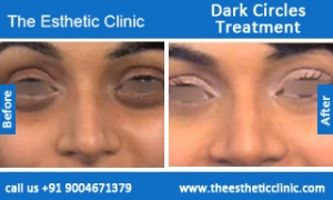 Dark-Circles-treatment-before-after-photos-mumbai-india-1 (4)