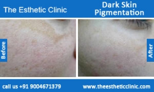 Dark-Skin-Pigmentation-treatment-before-after-photos-mumbai-india-1 (3)