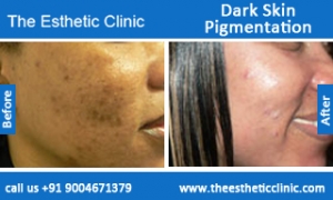 Dark-Skin-Pigmentation-treatment-before-after-photos-mumbai-india-1 (4)