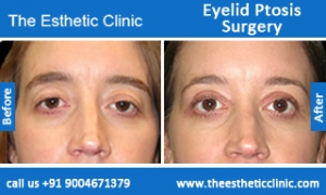 Eyelid-Ptosis-Surgery-before-after-photos-mumbai-india-4