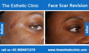 face-scar-revision-before-after-photos-mumbai-india-1