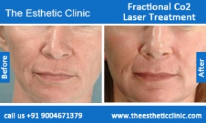 Fractional-Co2-Laser-treatment-before-after-photos-mumbai-india-1 (2)