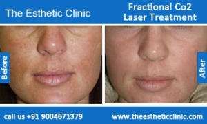 Fractional-Co2-Laser-treatment-before-after-photos-mumbai-india-1 (3)