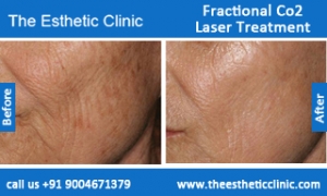 Fractional-Co2-Laser-treatment-before-after-photos-mumbai-india-1 (4)