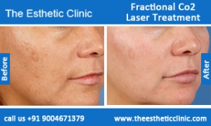 Fractional-Co2-Laser-treatment-before-after-photos-mumbai-india-1 (5)