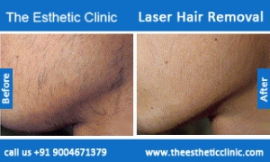 Laser-Hair-Removal-treatment-before-after-photos-mumbai-india-1 (1)