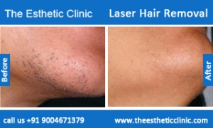 Laser-Hair-Removal-treatment-before-after-photos-mumbai-india-1 (2)