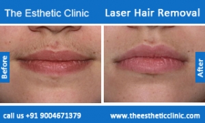 Laser-Hair-Removal-treatment-before-after-photos-mumbai-india-1 (4)