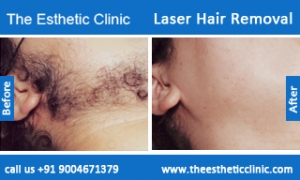 Laser-Hair-Removal-treatment-before-after-photos-mumbai-india-1 (5)