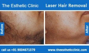 Laser-Hair-Removal-treatment-before-after-photos-mumbai-india-1 (6)