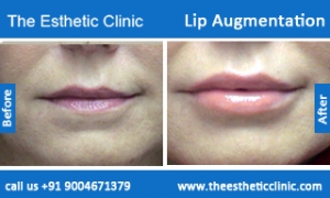 lip-augmentation-before-after-photos-mumbai-india-1