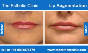 lip-augmentation-before-after-photos-mumbai-india-2