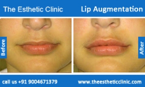 lip-augmentation-before-after-photos-mumbai-india-4