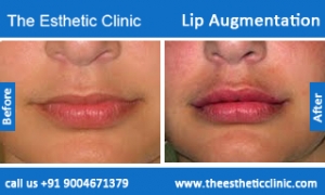 lip-augmentation-before-after-photos-mumbai-india-6