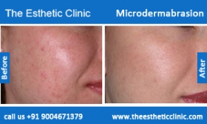 microdermabrasion-treatment-before-after-photos-mumbai-india-1 (2)