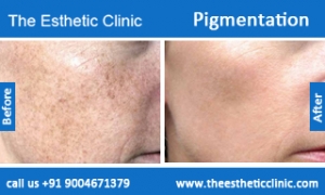 Pigmentation-treatment-before-after-photos-mumbai-india-1 (1)