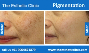 Pigmentation-treatment-before-after-photos-mumbai-india-1 (2)