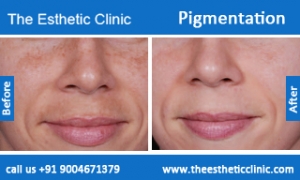 Pigmentation-treatment-before-after-photos-mumbai-india-1 (3)