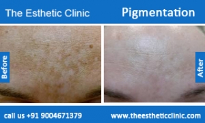 Pigmentation-treatment-before-after-photos-mumbai-india-1 (4)