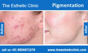 Pigmentation-treatment-before-after-photos-mumbai-india-1 (5)