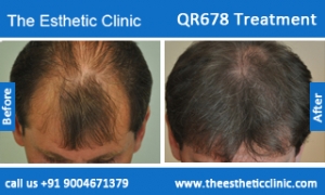 QR678-Treatment-3