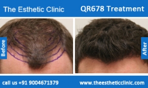 QR678-Treatment-4