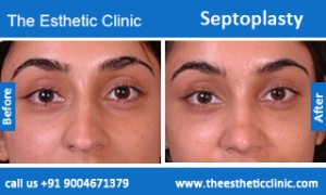 septoplasty-before-after-photos-mumbai-india-3