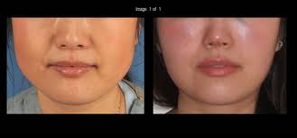 Botox for Masseter Hypertrophy