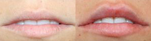 Lip Augmentation Filler Injections