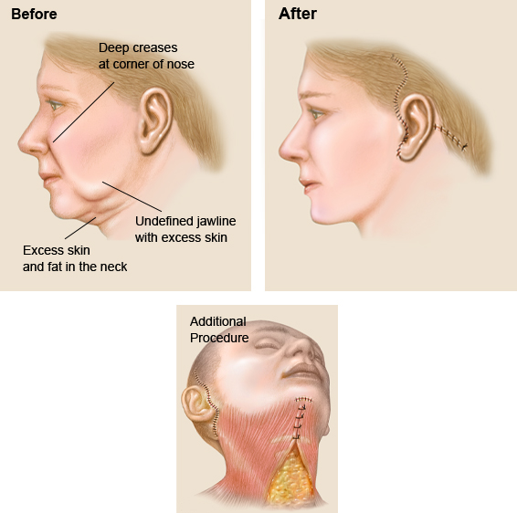 Facial Rhytidectomy 17