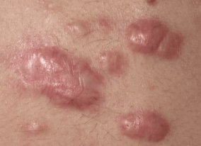 Keloid Scar of Skin: Symptoms, Causes, and Treatments
