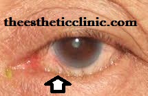Eyelid Diseases