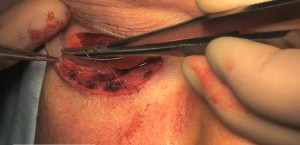 Lower eyelid reconstruction treatment Mumbai