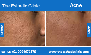 acne-treatment-before-after-photos-mumbai-india-1 (2)