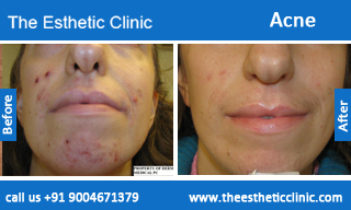 acne-treatment-before-after-photos-mumbai-india-1 (3)