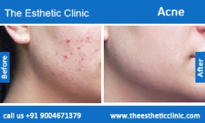 acne-treatment-before-after-photos-mumbai-india-1 (6)