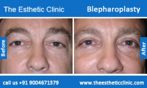 Blepharoplasty-before-after-photos-mumbai-india-2