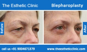 Blepharoplasty-before-after-photos-mumbai-india-4
